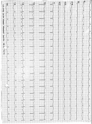 Takotsubo cardiomyopathy Afatinib-related in a non-small cell lung cancer patient: Case report